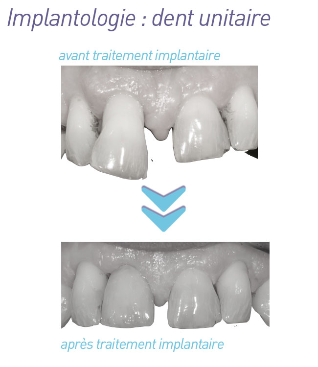 implantologie-dent_unitaire_avant-apres