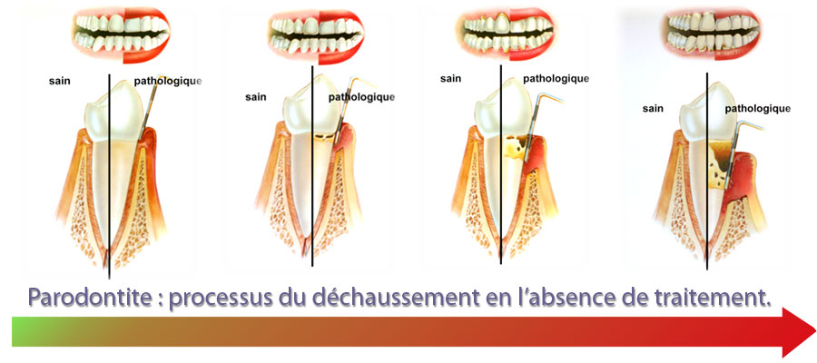 parodontologie04